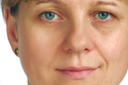 Correcting Scars or Marks