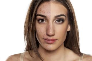 Essential Oils for Acne