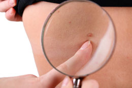 Mole Removal at Home
