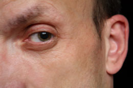 Dark Eyelids