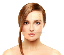 Hydrogen Peroxide for Acne