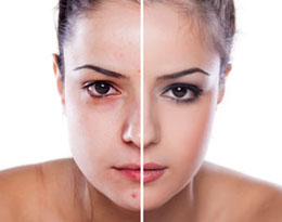 Makeup for Acne Prone Skin