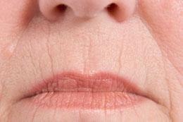 Lip Wrinkles