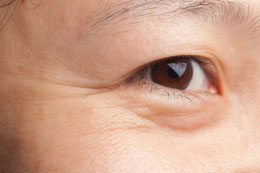 How to Remove Eye Wrinkles