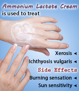 Uses and Side Effects of Ammonium Lactate Cream