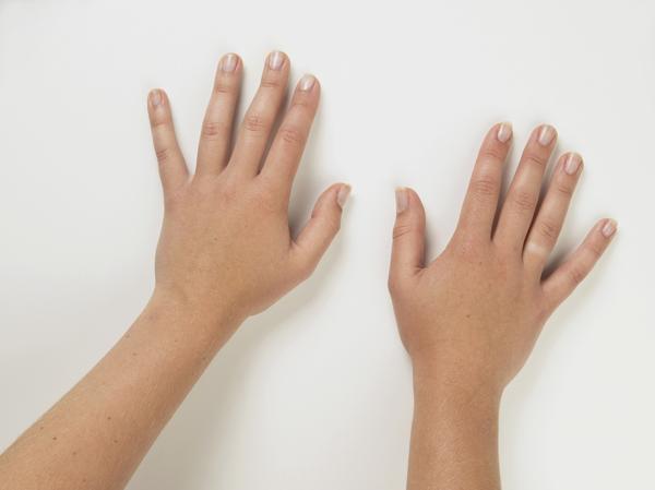 Pair of tanned hands palms down showing pale skin on ring finger