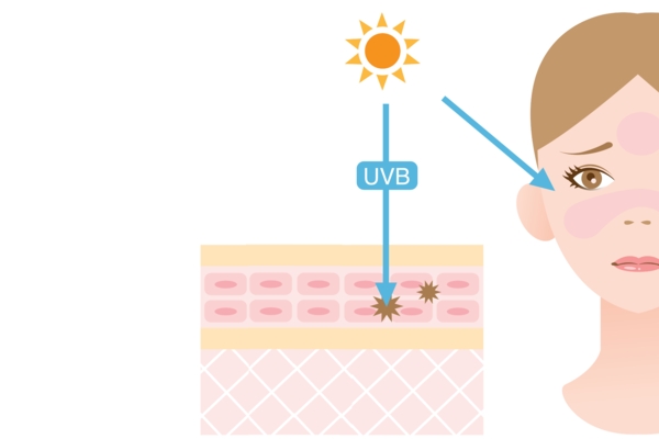 UVB rays